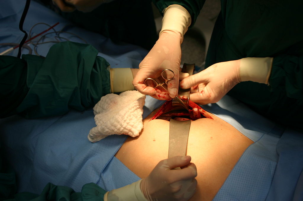 Трехкомпонентную операцию на сердце впервые в мире провели в Новосибирске