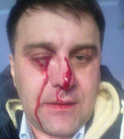 Виктор Агафонов сам обнародовал фотографии,  на которых виден ущерб, причиненный его здоровью в результате нападения депутата