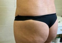 Новосибирский пластический хирург перепутал груди и ягодицы