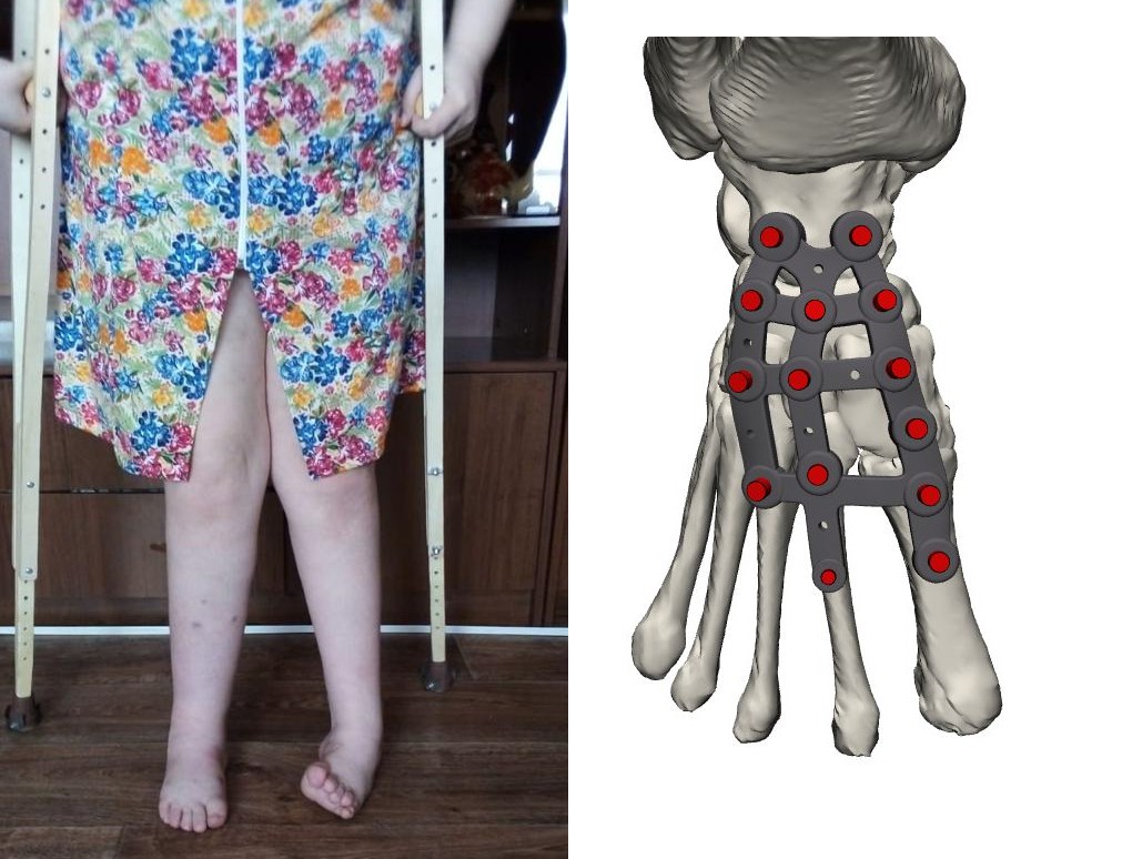 Новосибирские хирурги с помощью 3D-импланта исправили девочке ...