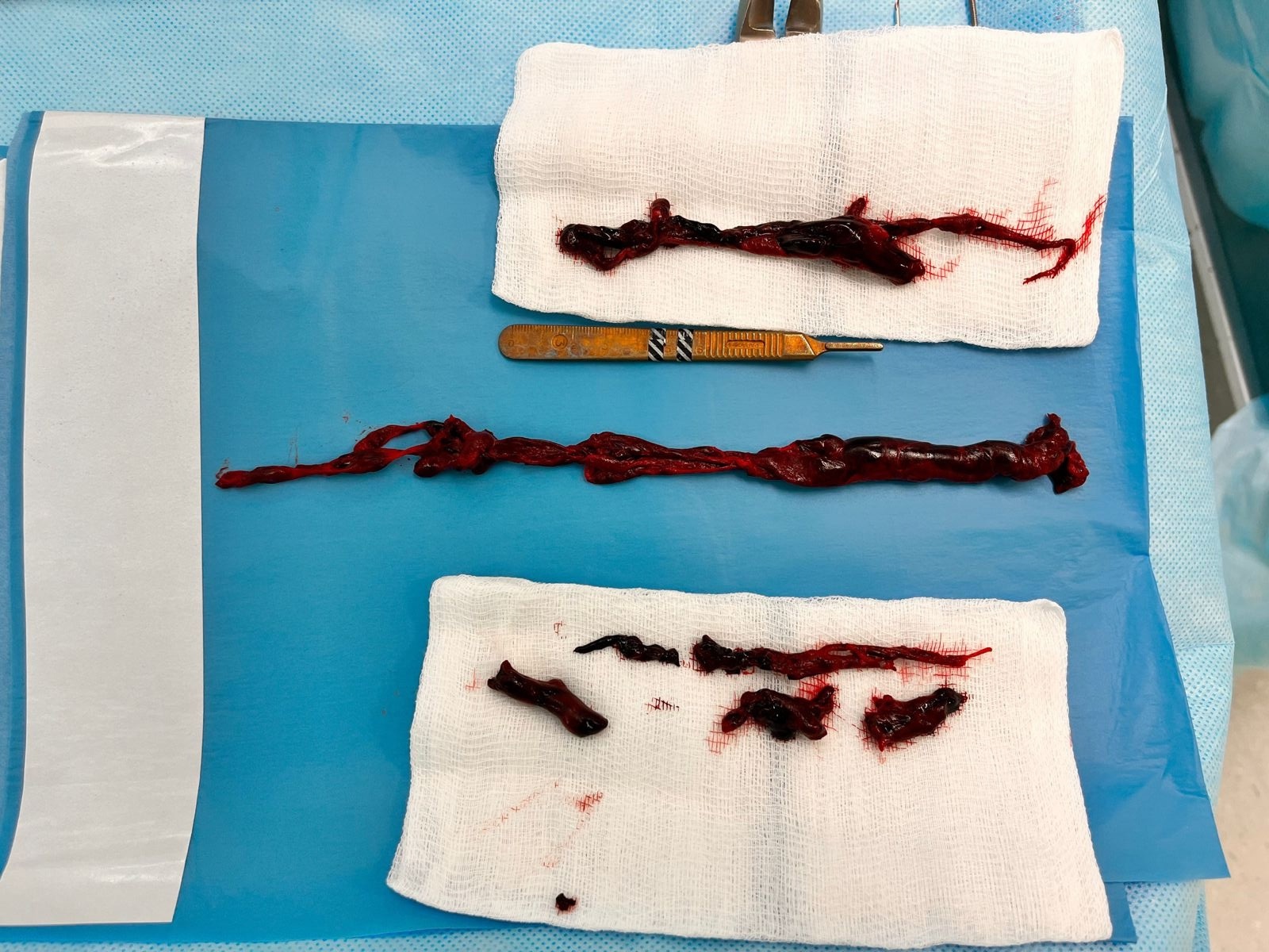 Чудом выжил: новосибирские хирурги извлекли из сердца мужчины 30-сантиметровый тромб