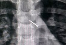 Новосибирские медики извлекли из бронхов ребенка канцелярскую кнопку