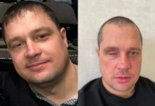 В Новосибирске охранник отеля лишился глаза после драки с пьяным байкером