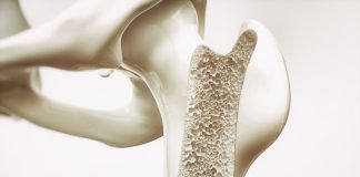 Всемирный день борьбы с остеопорозом: Как сохранить здоровье