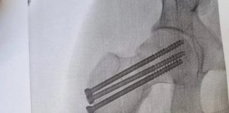 В Новосибирске служба доставки компенсировала курьеру перелом промокодом на 5000 рублей