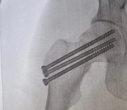 В Новосибирске служба доставки компенсировала курьеру перелом промокодом на 5000 рублей