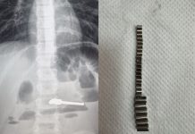 В Новосибирске 25 проглоченных магнитов проделали дыру в желудке ребенка