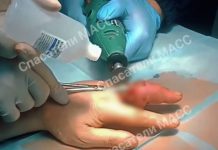 В Новосибирске мужчине едва не ампутировали палец из-за обручального кольца