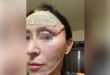 «Дырка вместо подбородка»: В Новосибирске женщина подала в суд после пластики