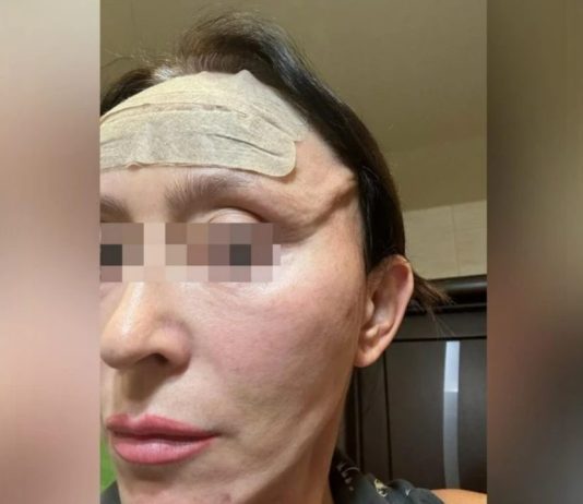 «Дырка вместо подбородка»: В Новосибирске женщина подала в суд после пластики
