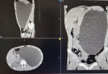 «Бомба замедленного действия»: Новосибирский подросток жил с гигантским пузырем вместо почки